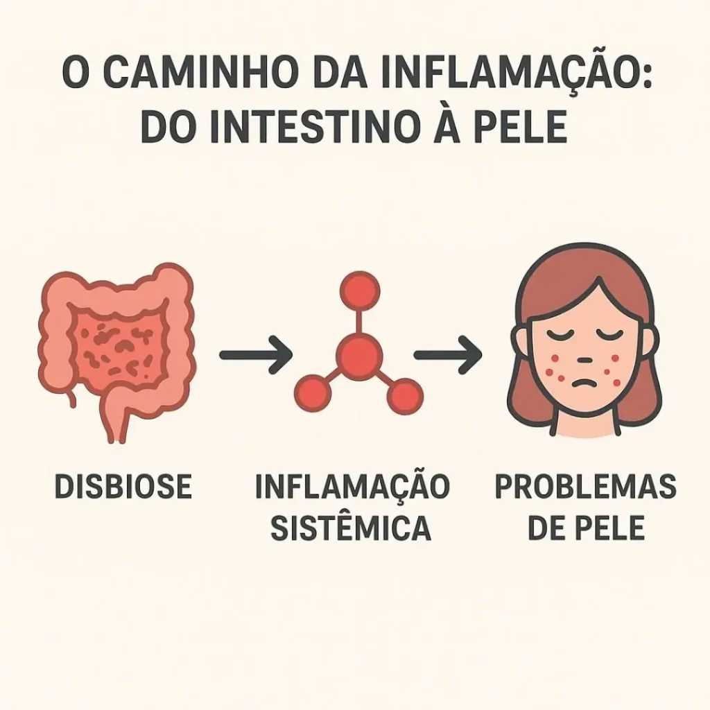 Infográfico explicando como a disbiose intestinal afeta a pele através da inflamação sistêmica